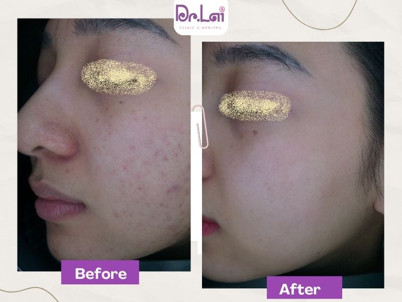 Cải thiện mụn rõ rệt sau 1 liệu trình