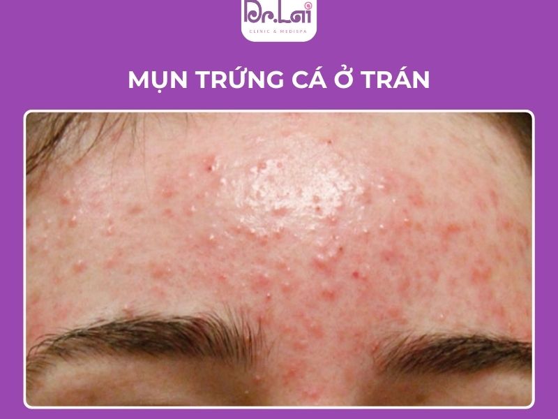 Nguyên nhân bị mụn trứng cá ở trán
