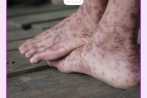 Cách trị viêm da cơ địa ở chân: Nên bôi gì và kiêng gì?