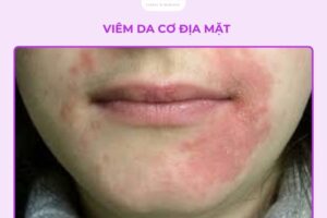 Cách trị viêm da cơ địa ở mặt tại nhà an toàn, giảm ngứa nhanh chóng