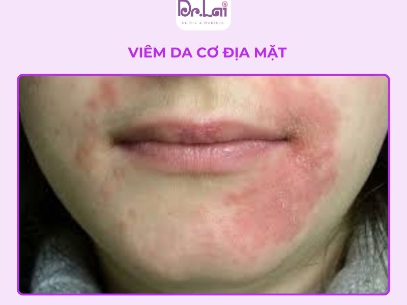 Viêm da cơ địa ở mặt