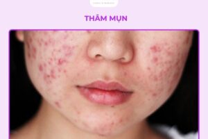 5+ Nguyên nhân gây ra thâm mụn và cách phòng ngừa hiệu quả