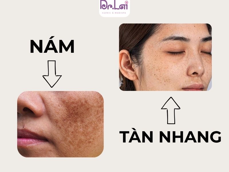 Phân biệt nám, tàn nhang