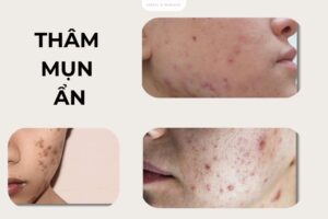 5+ Cách trị thâm mụn ẩn dành cho da nhạy cảm: Hiệu quả và an toàn