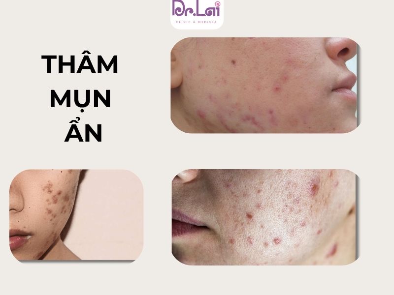 Nguyên nhân gây ra thâm mụn ẩn