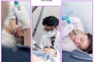 Bí quyết trị thâm mụn ở mặt giúp da phục hồi nhanh