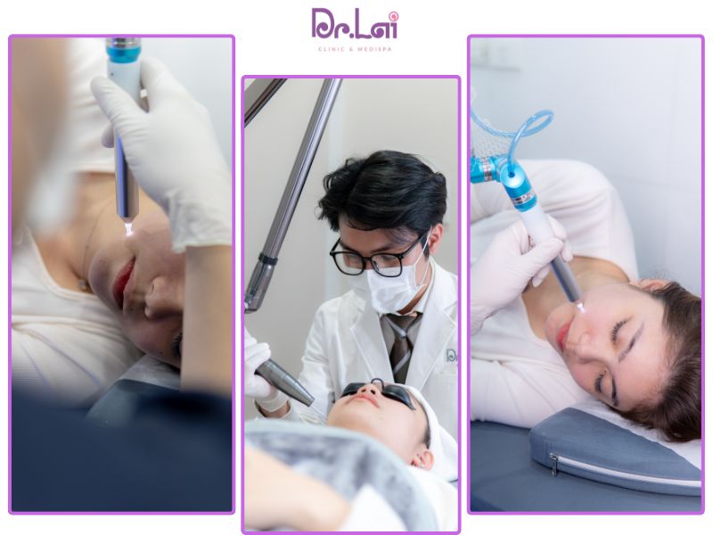 Cách trị thâm mụn ở mặt hiệu quả