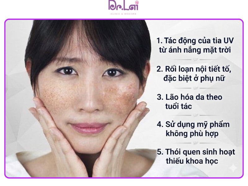 Nám tàn nhang có nhiều nguyên nhân