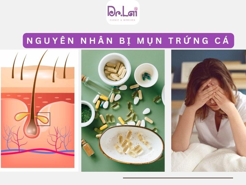 Nguyên nhân bị mụn trứng cá