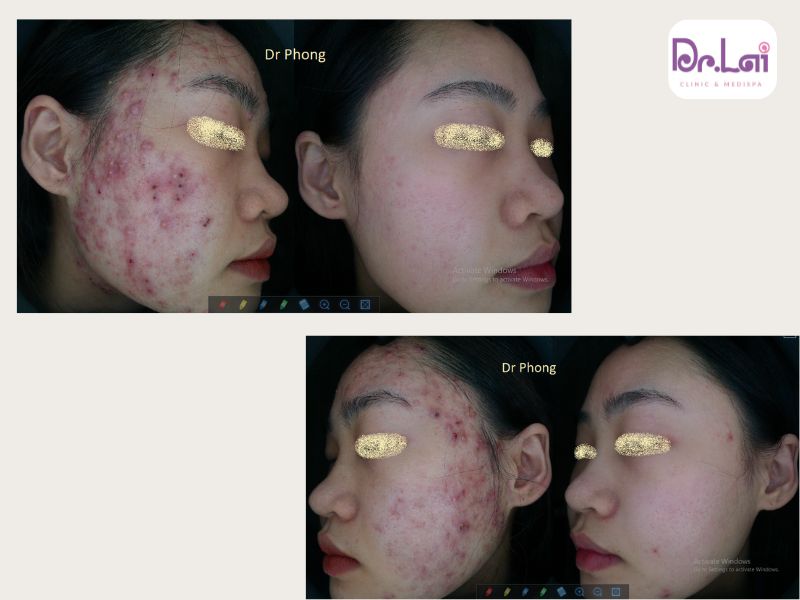 Hình ảnh thực tế khách điều trị mụn tại Dr.Lai