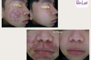 10+ cách trị mụn trứng cá hiệu quả, giúp da láng mịn, khỏe mạnh