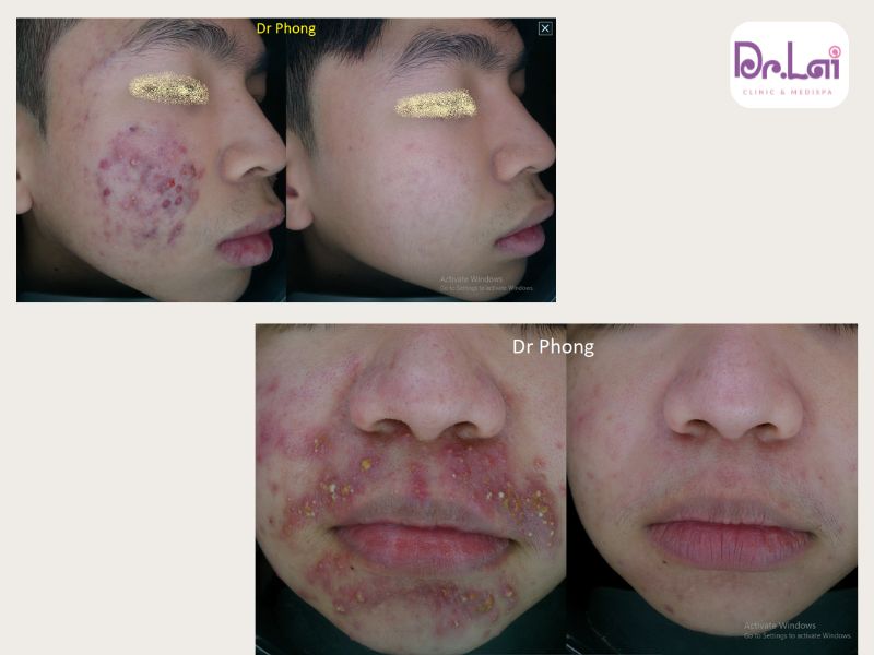 Các nốt mụn giảm rõ rệt sau 1 liệu trình