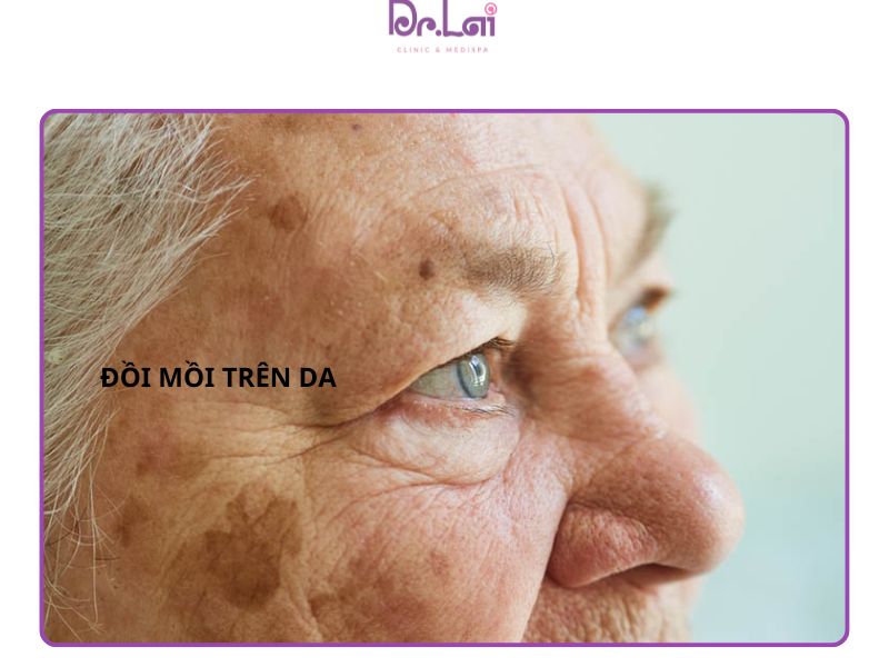 Đồi mồi trên da mặt