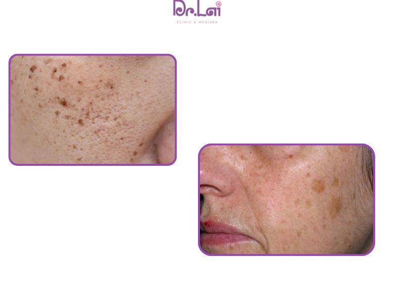 Các đốm đồi mồi trên da có thể do nhiều nguyên nhân khác nhau