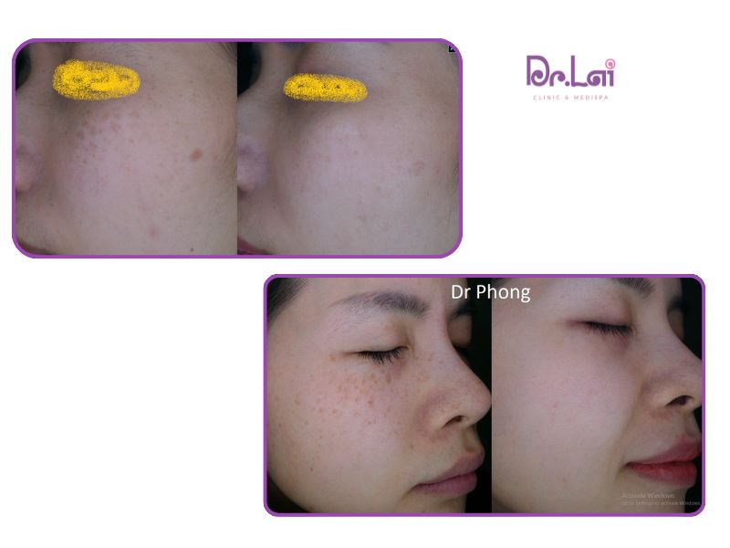 Hình ảnh trước và sau điều trị đồi mồi, tàn nhang tại Dr. Lai