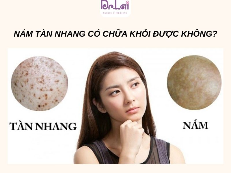 Bị nám tàn nhang có chữa được không?