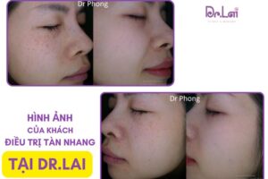Giải đáp: Nám tàn nhang có chữa được không?