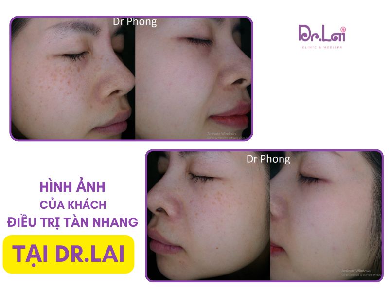 Hình ảnh thực tế khách điều trị tàn nhang tại Dr.Lai