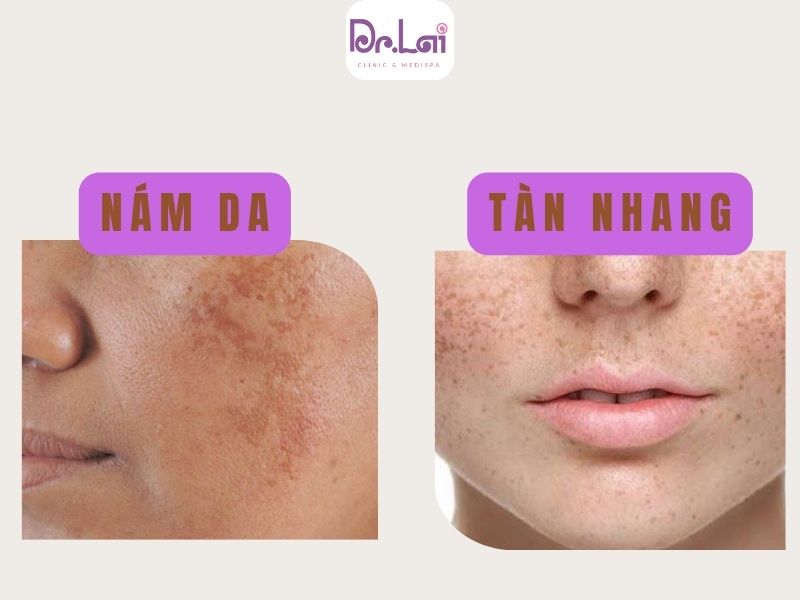 Nám da và tàn nhang là 2 vấn đề khác biệt