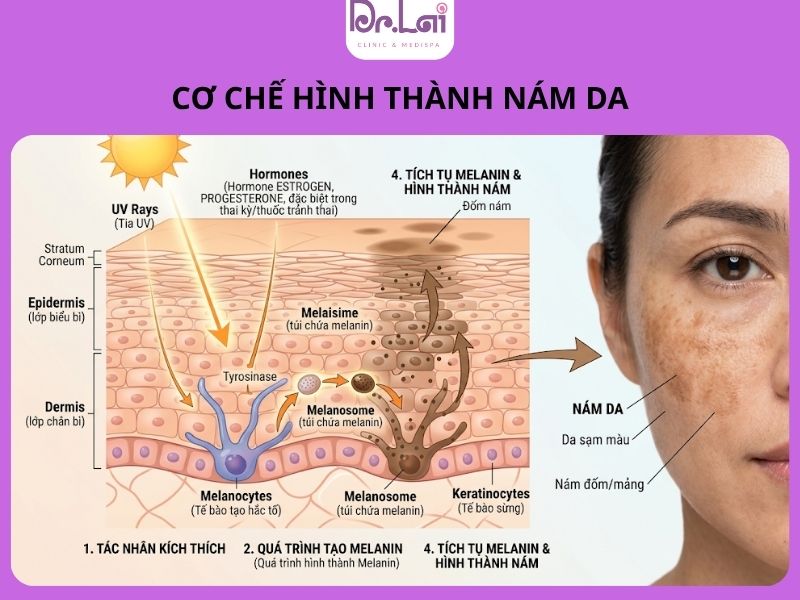 Cơ chế hình thành nám da