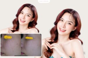 Quy trình chăm sóc da nám tàn nhang sau điều trị hạn chế tái phát