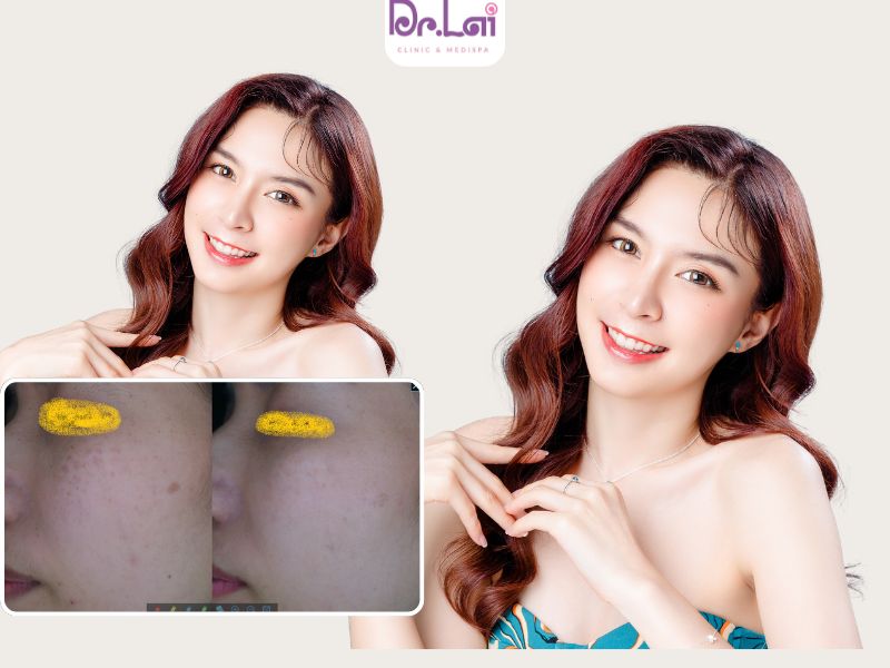 Quy trình chăm sóc da nám tàn nhan