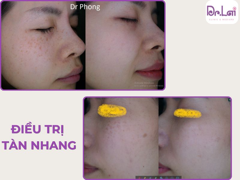 Làn da sau điều trị tàn nhang tại Dr.Lai