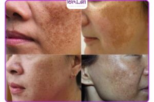 Cách chữa tàn nhang đồi mồi ở mặt hiệu quả nhất hiện nay