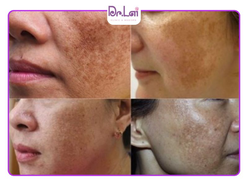 Tàn nhang và đồi mồi trên da mặt
