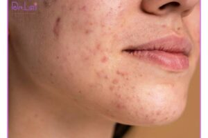Cách điều trị mụn cho da nhạy cảm an toàn, hiệu quả