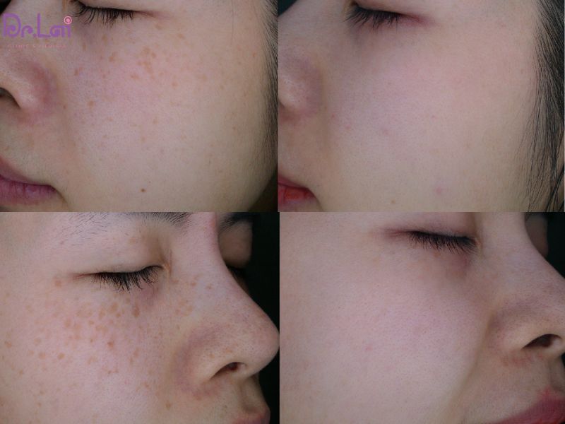 Hiệu quả điều trị tàn nhang của khách tại Dr.Lai