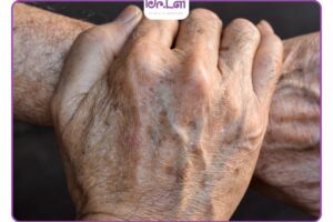 7 cách trị đồi mồi ở tay tại nhà dứt điểm, nguyên liệu dễ kiếm