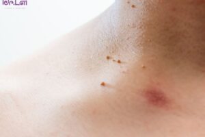 Cách trị mụn thịt ở cổ nhanh và hiệu quả nhất