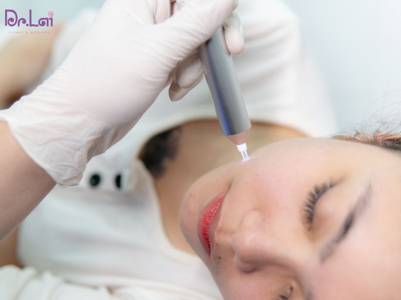 Điều trị mụn bằng phương pháp laser