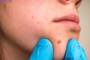 Cách trị mụn thịt tận gốc an toàn nhất