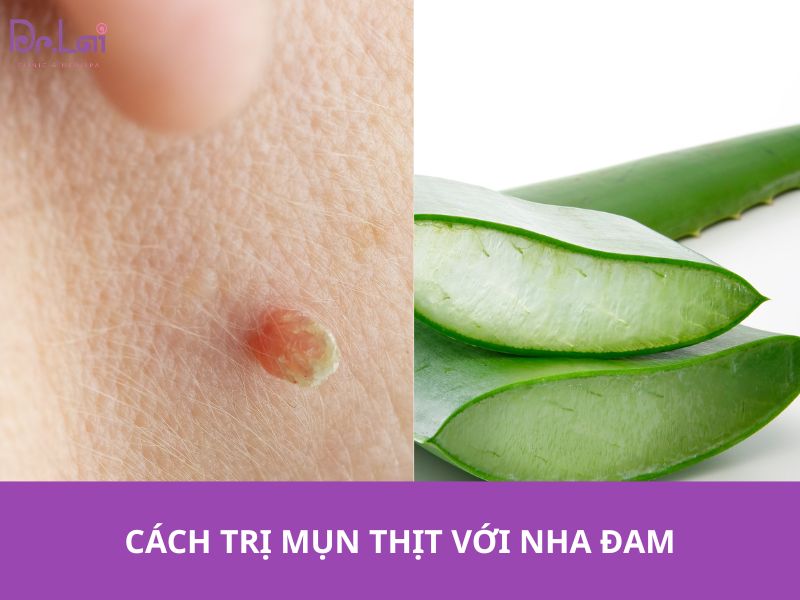 Thuốc bôi đặc trị chỉ phù hợp với mụn nhỏ