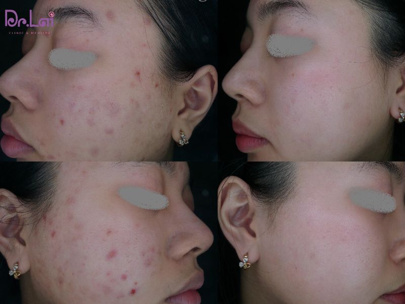 Hình ảnh thực tế của khách sau khi điều trị mụn tại Dr. Lai