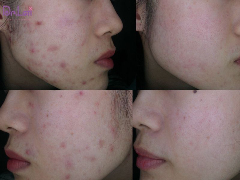 Hình ảnh thực tế của khách sau khi điều trị mụn tại Dr. Lai sau 1 liệu trình
