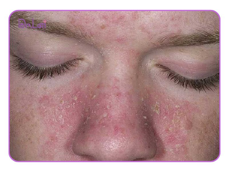Viêm da tiếp xúc dị ứng