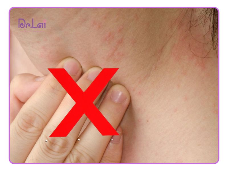 Tránh gãi và bảo vệ vùng da tổn thương