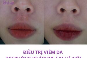 Cách điều trị viêm da tiếp xúc dị ứng khỏi dứt điểm