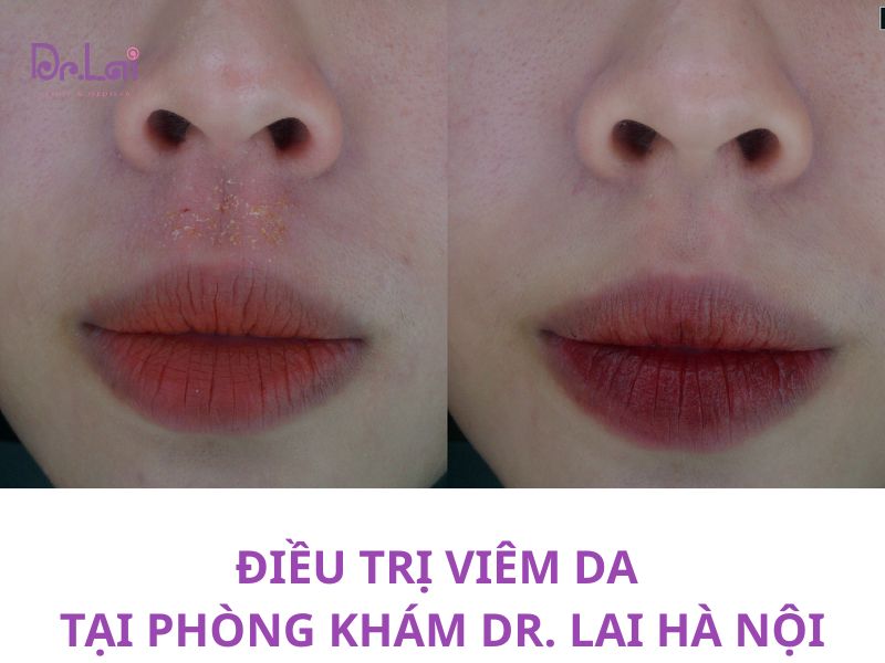 Hình ảnh thực tế điều trị viêm da tại phòng khám da liễu Dr. Lai