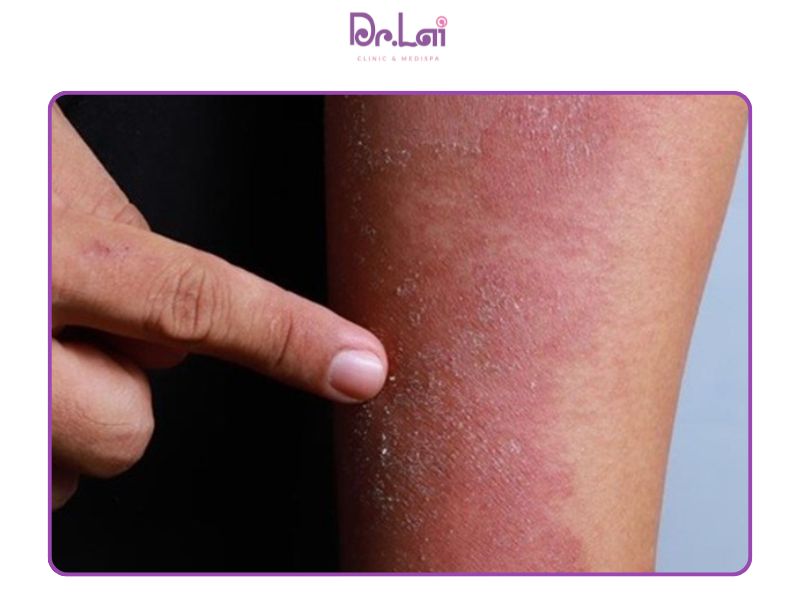 Khô da, bong tróc khi bị viêm da cơ địa