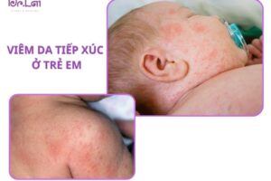 Cách điều trị viêm da tiếp xúc ở trẻ em an toàn