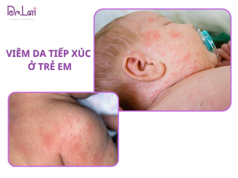 Viêm da tiếp xúc ở trẻ em