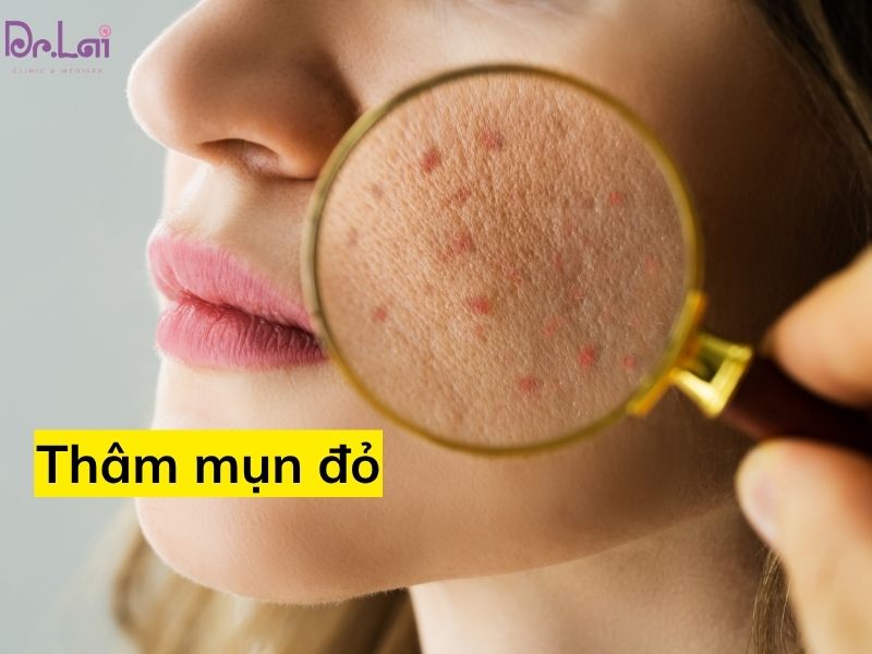 Hình ảnh thâm mụn đỏ