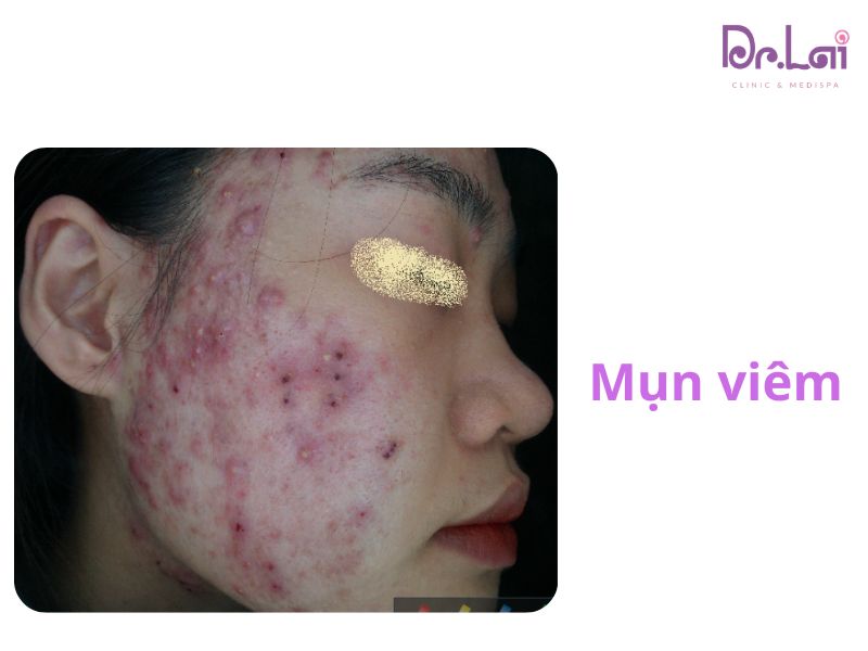 Mụn viêm gây mất thẩm mỹ và tự tin