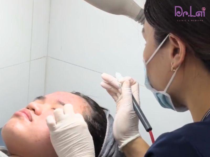 Điều trị mụn tại Dr. Lai