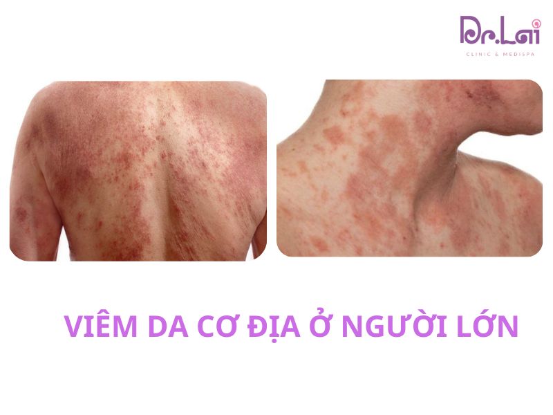Viêm da cơ địa ở người lớn
