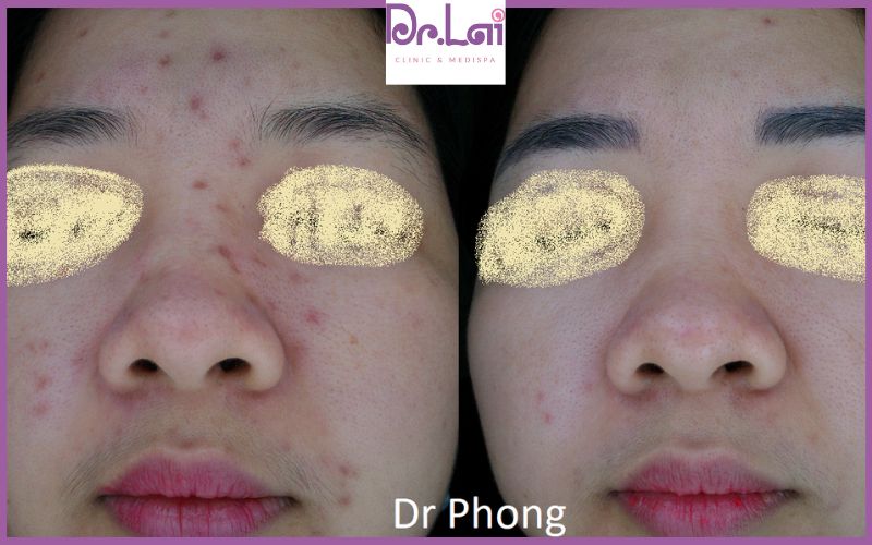 Cải thiện bề mặt da lõm